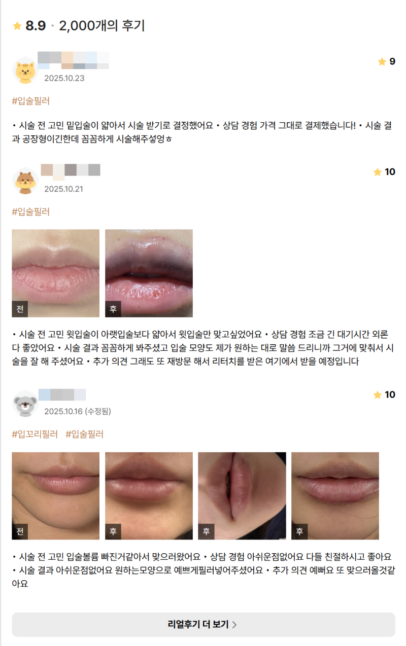 입술 가로확장 필러 vs 볼륨 필러, 진짜 차이? 사진 6