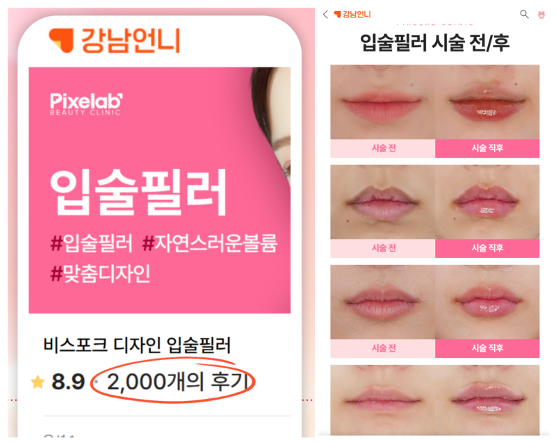 입술 가로확장 필러 vs 볼륨 필러, 진짜 차이? 사진 4