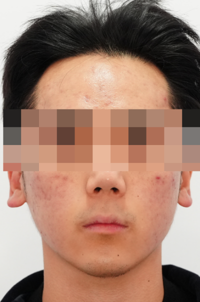 여드름 치료, 왜 또 올라올까? 사진 4