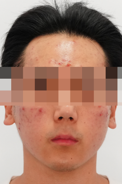 여드름 치료, 왜 또 올라올까? 사진 3