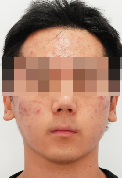 여드름 치료, 왜 또 올라올까? 사진 2