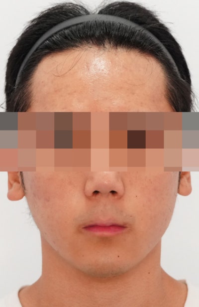 여드름 치료, 왜 또 올라올까? 사진 5