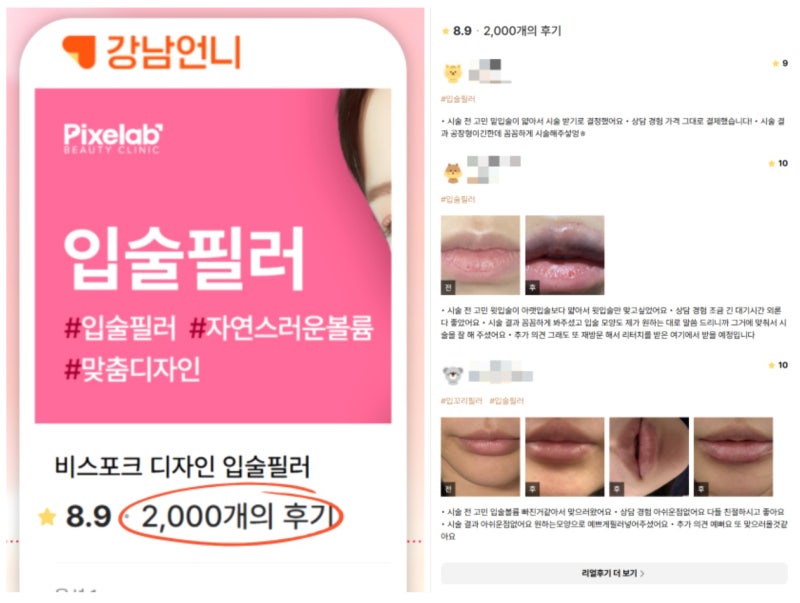 강남역 자연스러운입술필러 후기 2000개 돌파, 그 비결은?
