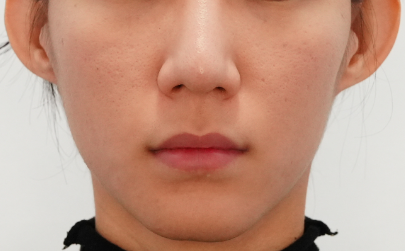 여드름 흉터 제거, 울트라펄스 알파로 달라진 치료 접근 사진 3