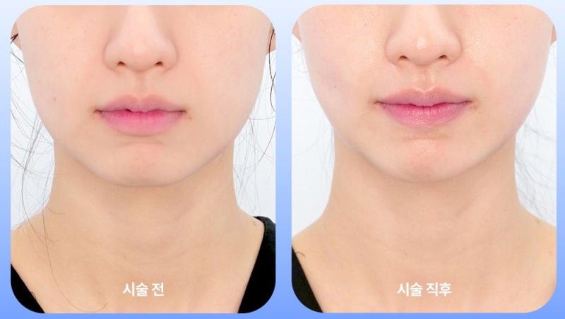 한가인 덴서티, 덴서티효과 차이 나는 이유는? 사진 4