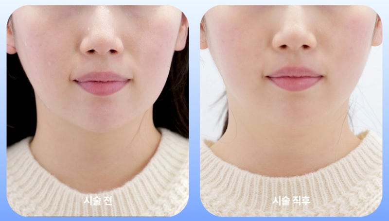한가인 덴서티, 덴서티효과 차이 나는 이유는? 사진 3