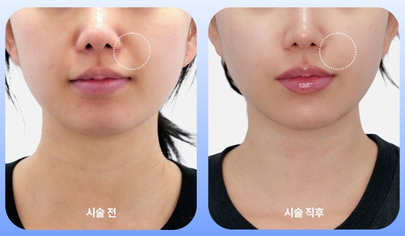 쥬베룩 볼륨 팔자주름, 필러 대신 선택하는 이유 사진 2