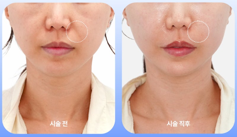 쥬베룩 볼륨 팔자주름, 필러 대신 선택하는 이유 사진 3
