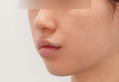여드름 흉터 없애는법, 포텐자 샷 수 늘리기 전에 꼭 봐야 할 기준