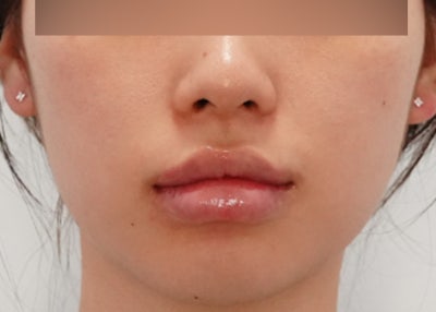 여드름 흉터 없애는법, 포텐자 샷 수 늘리기 전에 꼭 봐야 할 기준 사진 8