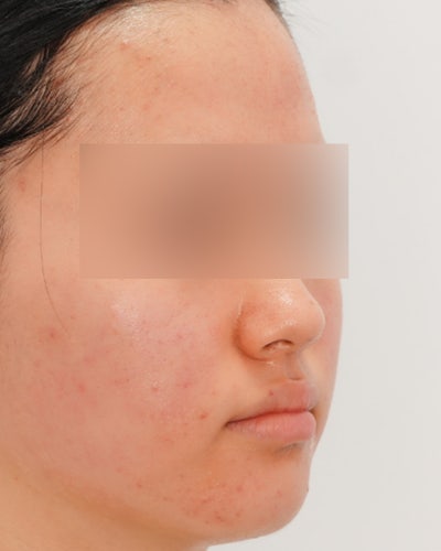 여드름치료법, '빨리 없애야 한다'는 생각이 흉터를 만듭니다 사진 4