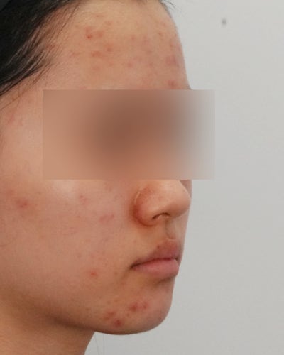 여드름치료법, '빨리 없애야 한다'는 생각이 흉터를 만듭니다 사진 2