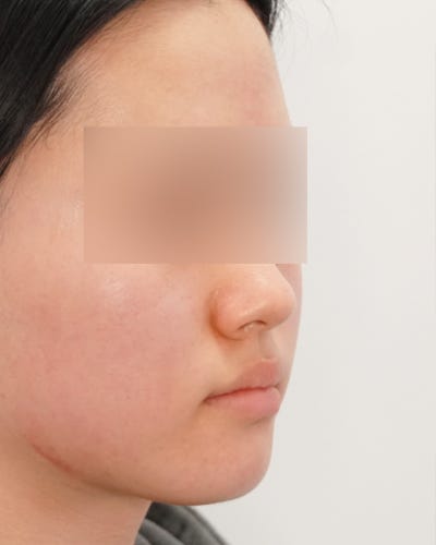 여드름치료법, '빨리 없애야 한다'는 생각이 흉터를 만듭니다 사진 6