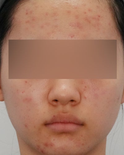 여드름치료법, '빨리 없애야 한다'는 생각이 흉터를 만듭니다