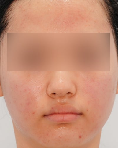 여드름치료법, '빨리 없애야 한다'는 생각이 흉터를 만듭니다 사진 3