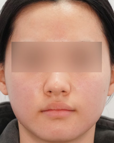 여드름치료법, '빨리 없애야 한다'는 생각이 흉터를 만듭니다 사진 5