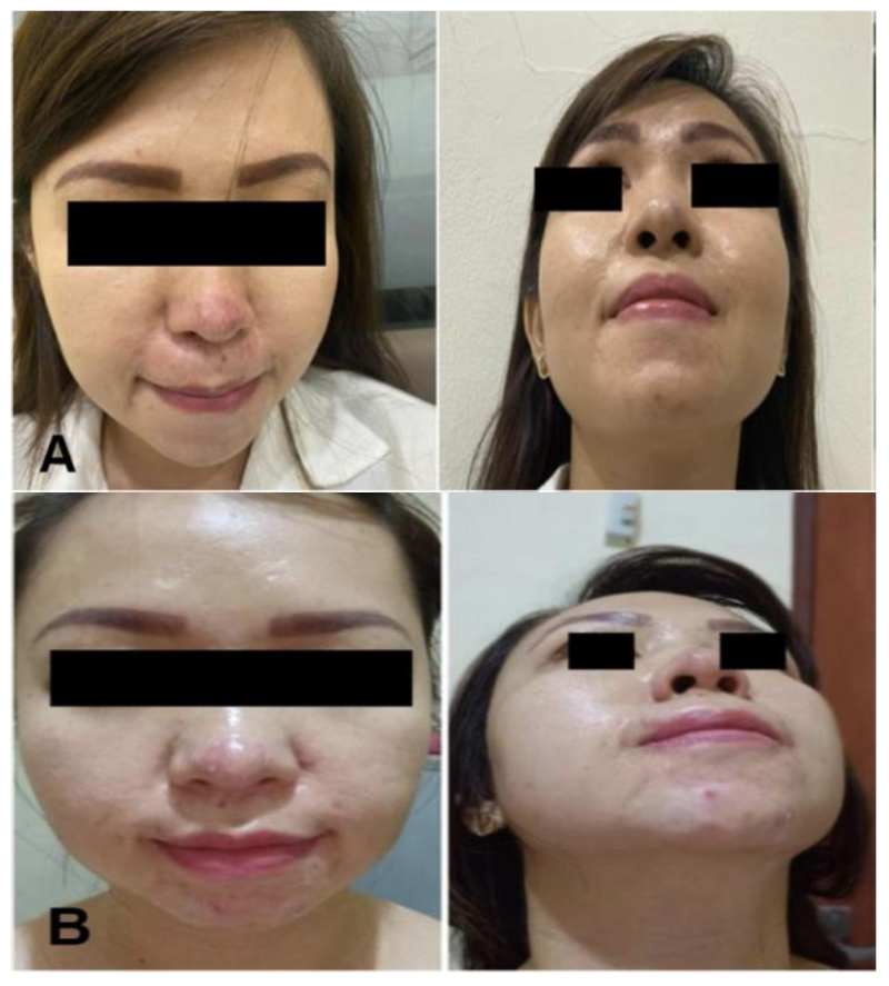 필러 괴사, 고압산소챔버 없는 병원이 위험한 이유 사진 5