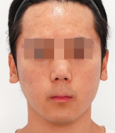 염증주사 패임보다 무서운 건, 타이밍을 놓친 염증입니다 사진 9