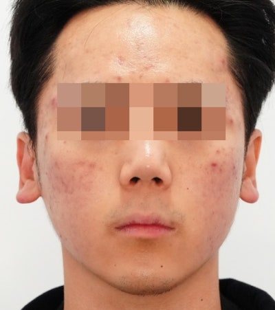 염증주사 패임보다 무서운 건, 타이밍을 놓친 염증입니다 사진 8