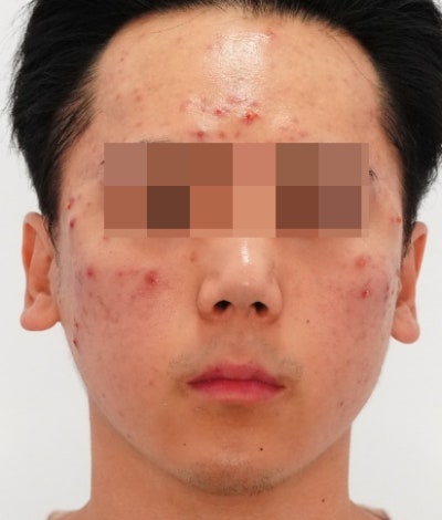 염증주사 패임보다 무서운 건, 타이밍을 놓친 염증입니다 사진 7