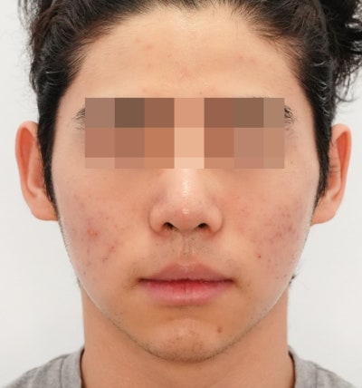 염증주사 패임보다 무서운 건, 타이밍을 놓친 염증입니다 사진 11