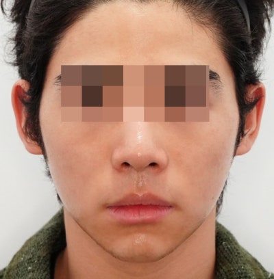 염증주사 패임보다 무서운 건, 타이밍을 놓친 염증입니다 사진 12