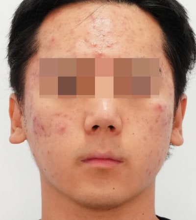 염증주사 패임보다 무서운 건, 타이밍을 놓친 염증입니다 사진 6