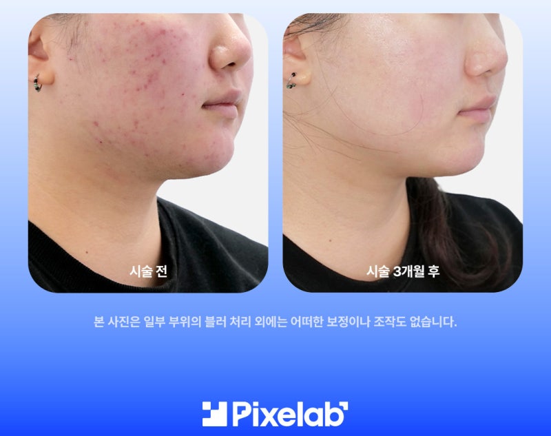 여드름 자국 치료 5회 이상 받아도 효과 없는 이유 사진 2