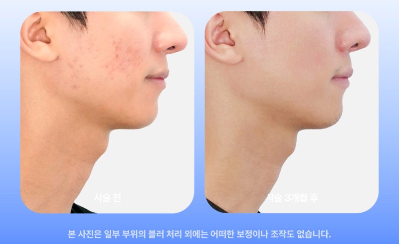 여드름 자국 치료 5회 이상 받아도 효과 없는 이유 사진 12