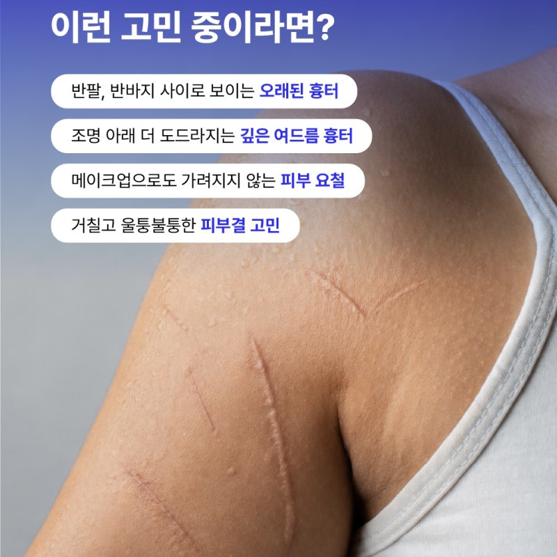 여드름 자국 치료 5회 이상 받아도 효과 없는 이유 사진 17