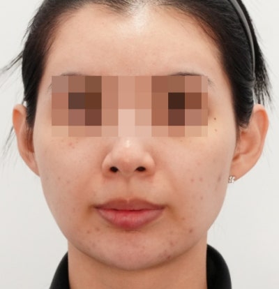 포텐자 부작용, 딱지·홍조는 정상! 꼭 확인해야 할 위험 신호는? 사진 8