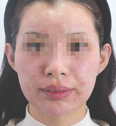 포텐자 부작용, 딱지·홍조는 정상! 꼭 확인해야 할 위험 신호는? 사진 7