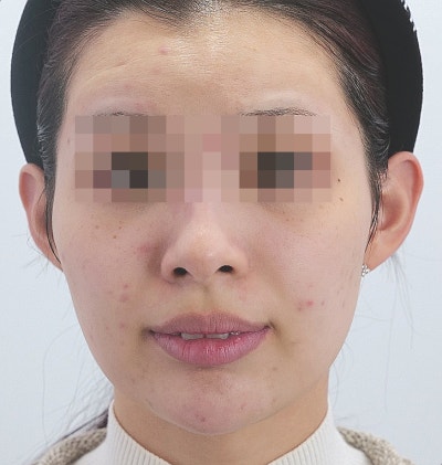 포텐자 부작용, 딱지·홍조는 정상! 꼭 확인해야 할 위험 신호는? 사진 6
