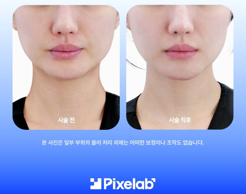 덴서티 알파팁, 클래식·하이팁과의 차이점 3가지 - 알파 엠버서더가 설명드립니다! 사진 8