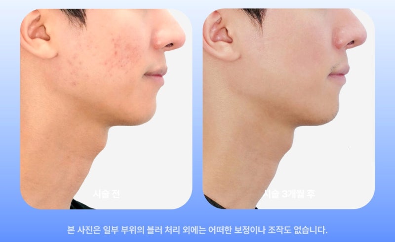 포텐자 여드름흉터, 3회차 효과 없다면? 꼭 확인해야할 1가지! 사진 8