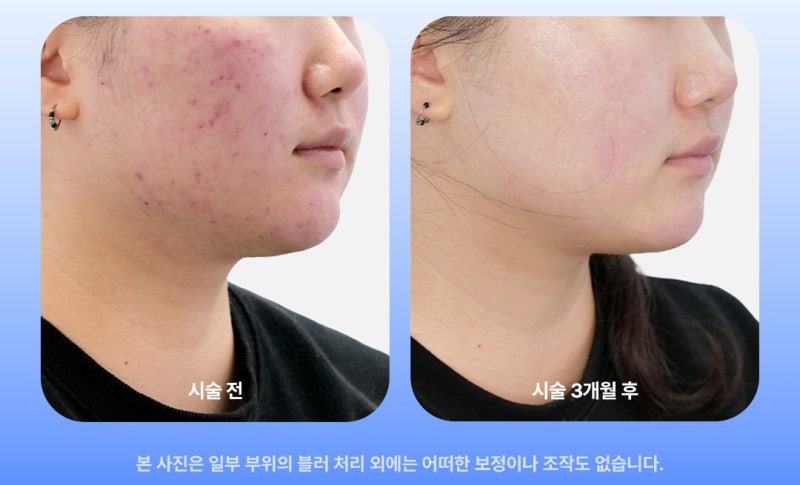 피부결·모공·흉터 고민이라면? 울트라펄스 알파로 한 번에 해결하세요! 사진 7
