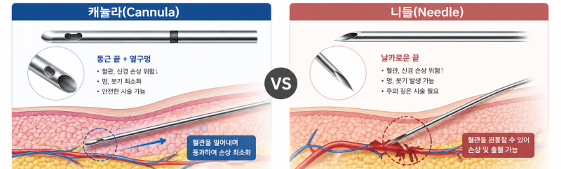 관자필러 후기, '옆광대’ 도드라짐 없는 라인 만드는 픽셀랩의 4가지 공식 사진 4
