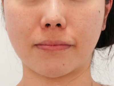 신논현 포텐자 주기, '한 달에 한 번'이 정답이 아닌 이유 사진 6