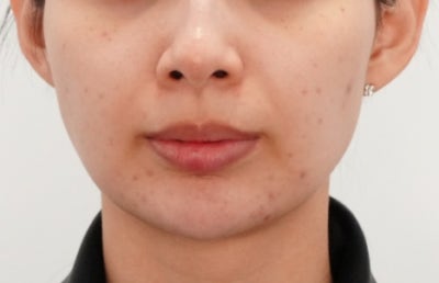 신논현 포텐자 주기, '한 달에 한 번'이 정답이 아닌 이유 사진 5