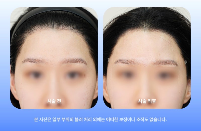 관자필러, 매끄러운 옆라인으로 만드는 면접프리패스상 사진 10