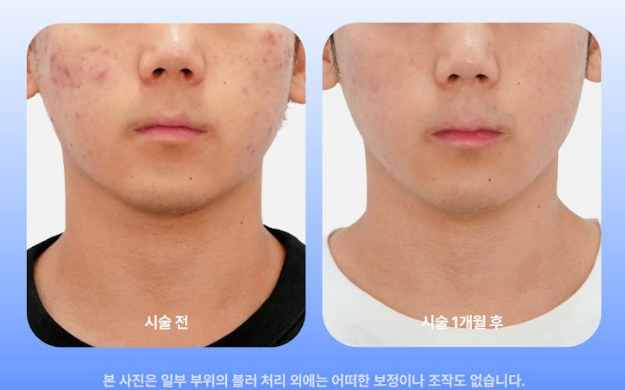 울트라펄스 흉터 레이저 치료, 성형외과 전문의에게 받아야 하는 이유 사진 13