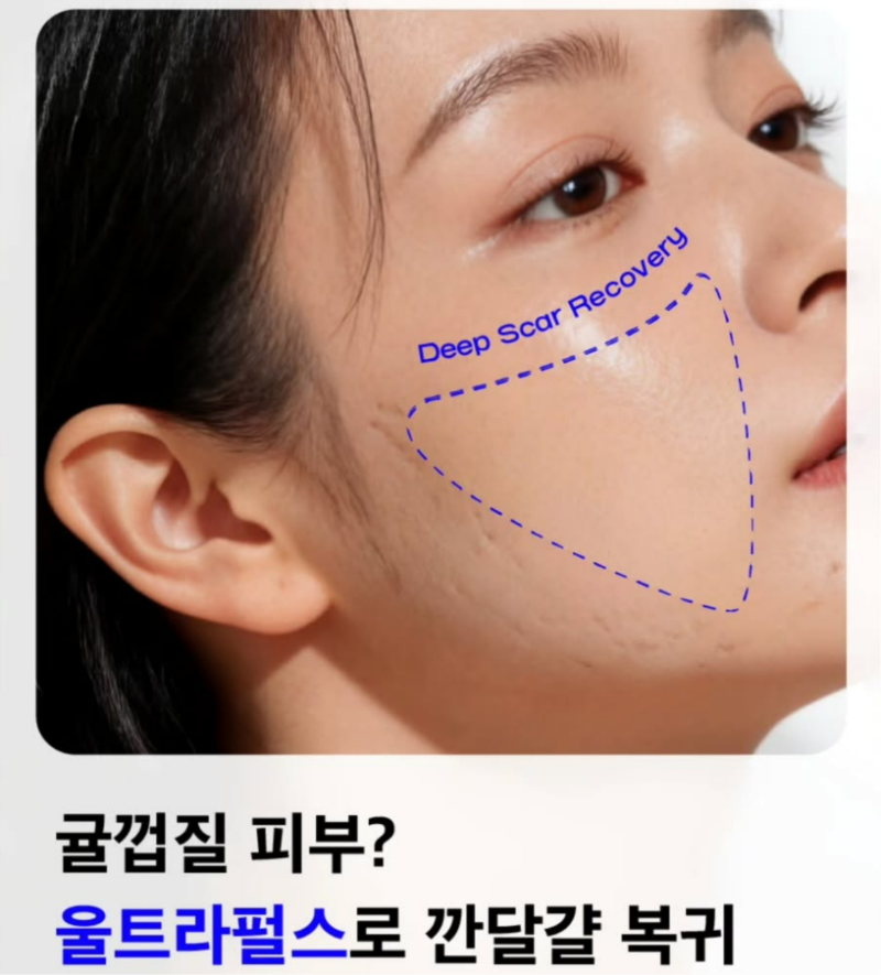 울트라펄스 흉터 레이저 치료, 성형외과 전문의에게 받아야 하는 이유 사진 18