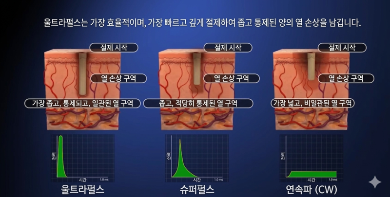 울트라펄스 다운타임 얼마나 걸리나요? 깊은 여드름흉터라면 꼭 체크하세요 사진 4