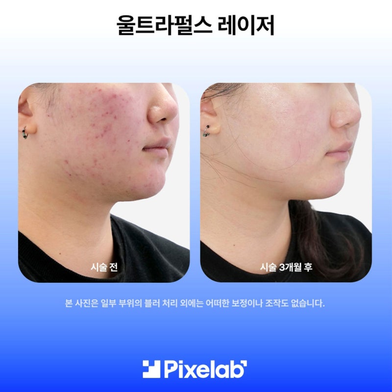 울트라펄스 다운타임 얼마나 걸리나요? 깊은 여드름흉터라면 꼭 체크하세요 사진 3