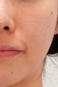 포텐자 모공팁 펌핑팁 차이, 내 피부엔 뭐가 맞을까 사진 8