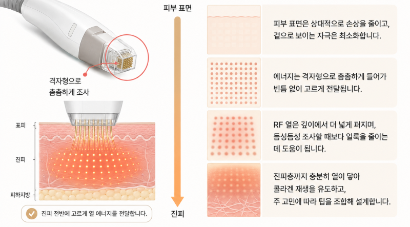 포텐자 모공팁 펌핑팁 차이, 내 피부엔 뭐가 맞을까 사진 7