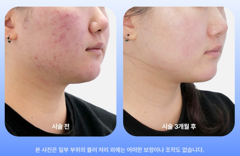 패인흉터 레이저 울트라펄스 알파, 기존 흉터 레이저랑 뭐가 다른 걸까요? 사진 7