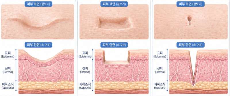 패인흉터 레이저 울트라펄스 알파, 기존 흉터 레이저랑 뭐가 다른 걸까요? 사진 11