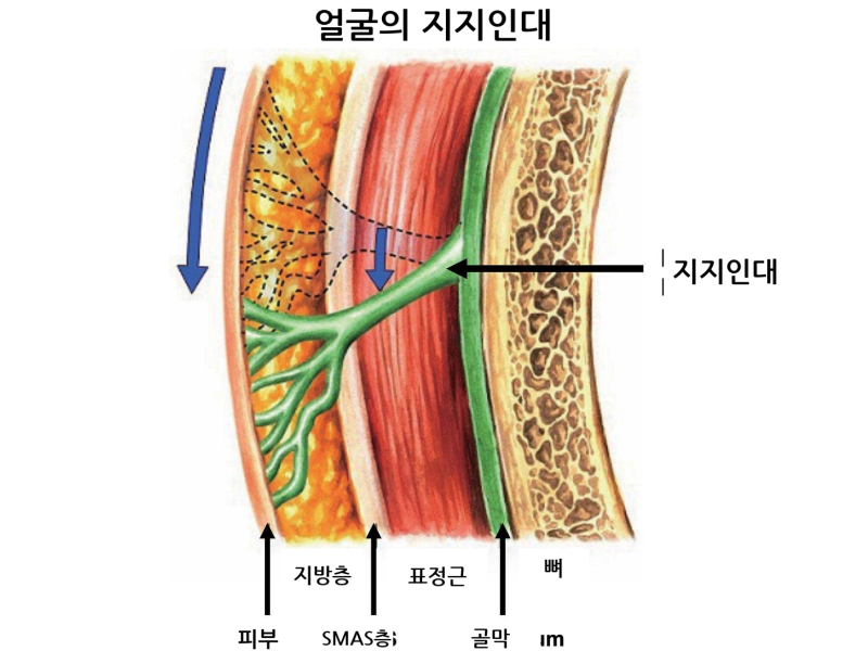 티타늄 리프팅 통증, 정말 없을까? 걱정 된다면 알아야 할 3가지 사진 3
