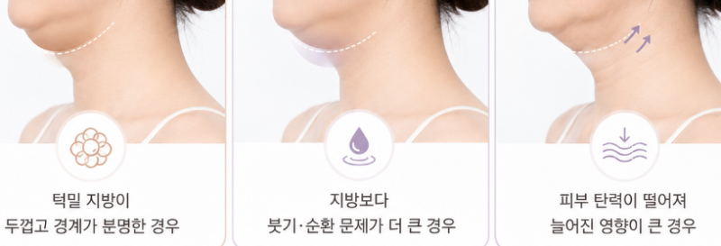 이중턱 지방분해주사, U라인이 V라인으로 바뀌는 단계와 3가지 타입 사진 4